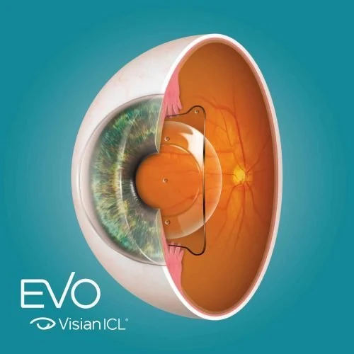 Ilustração anatômica do olho com a lente fácica EVO Visian ICL implantada