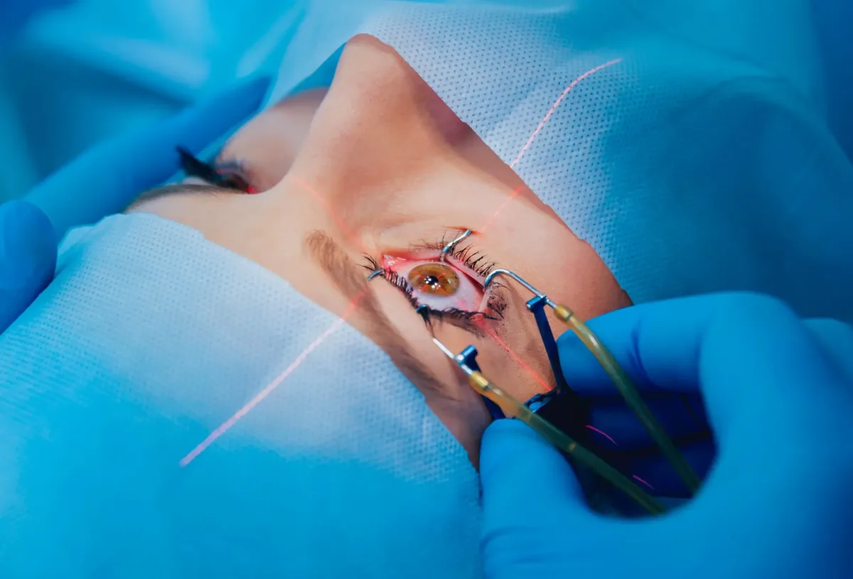 Cirurgião oftalmologista, de touca e lupa cirúrgica, durante uma cirurgia refrativa