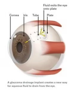Ilustração da válvula de drenagem para glaucoma, com o tubo inserido no olho (legendas em inglês, como publicadas pela clínica)